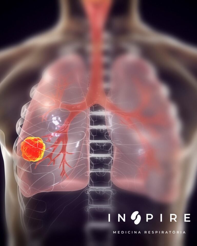 Fatores de Risco para o Câncer de Pulmão