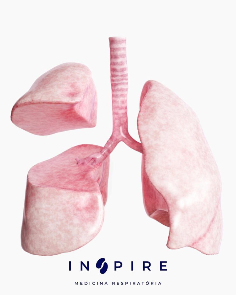 O que é a Lobectomia Pulmonar e Quando é Indicada?