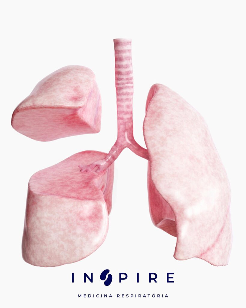 O que é a Lobectomia Pulmonar e Quando é Indicada?