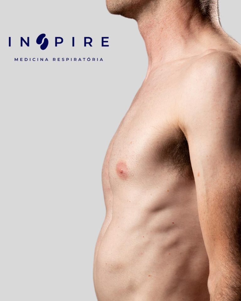 Pectus Excavatum: Como a Cirurgia Pode Melhorar a Qualidade de Vida
